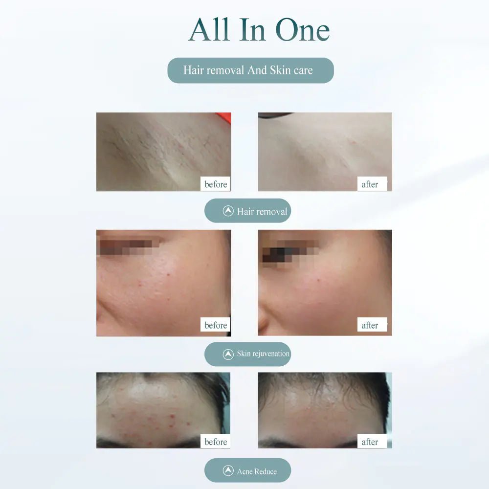 Laser Hair Removal Device - Painless Hair Removal Tool - Pure Bliss Beauty