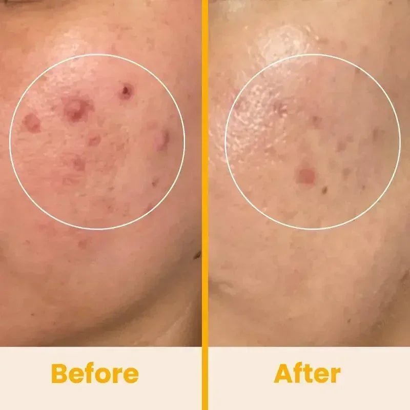 Radiant Skin High Frequency Wand™ - Pure Bliss Beauty