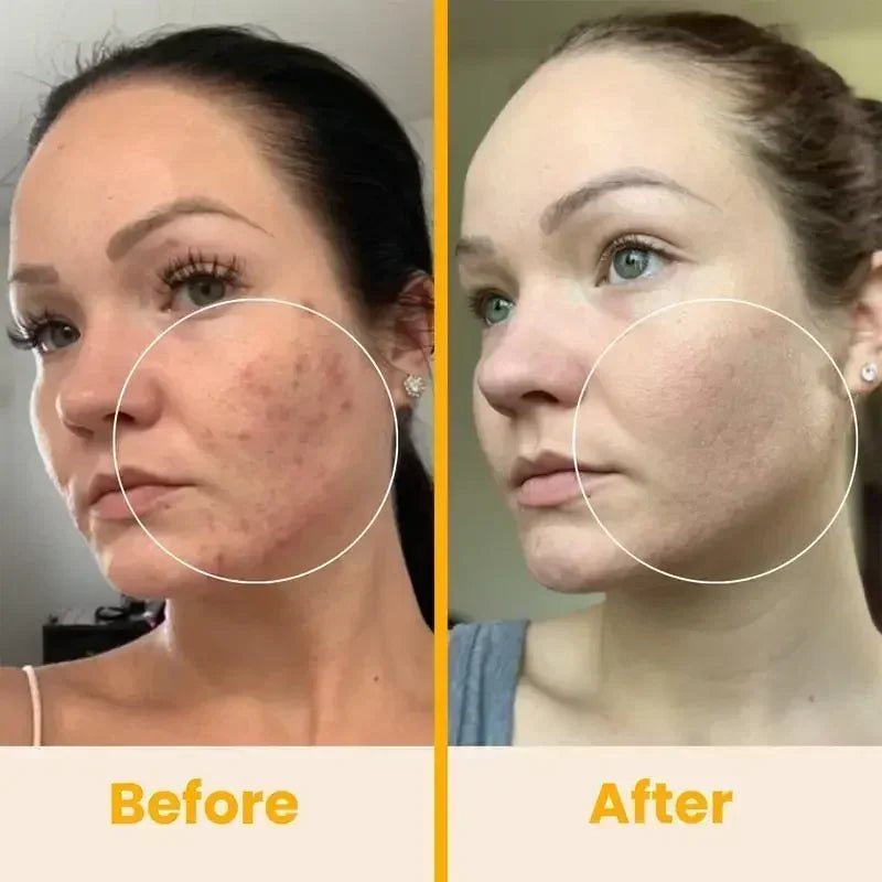 Radiant Skin High Frequency Wand™ - Pure Bliss Beauty